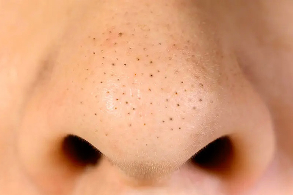Blackheads: What They Are and How to Treat Them