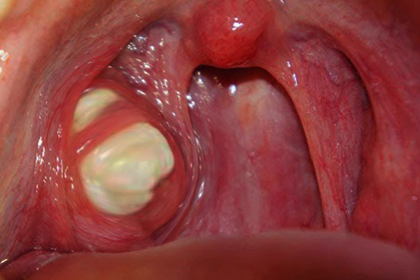 tonsil-stones-what-they-are-and-why-they-cause-ear-pain